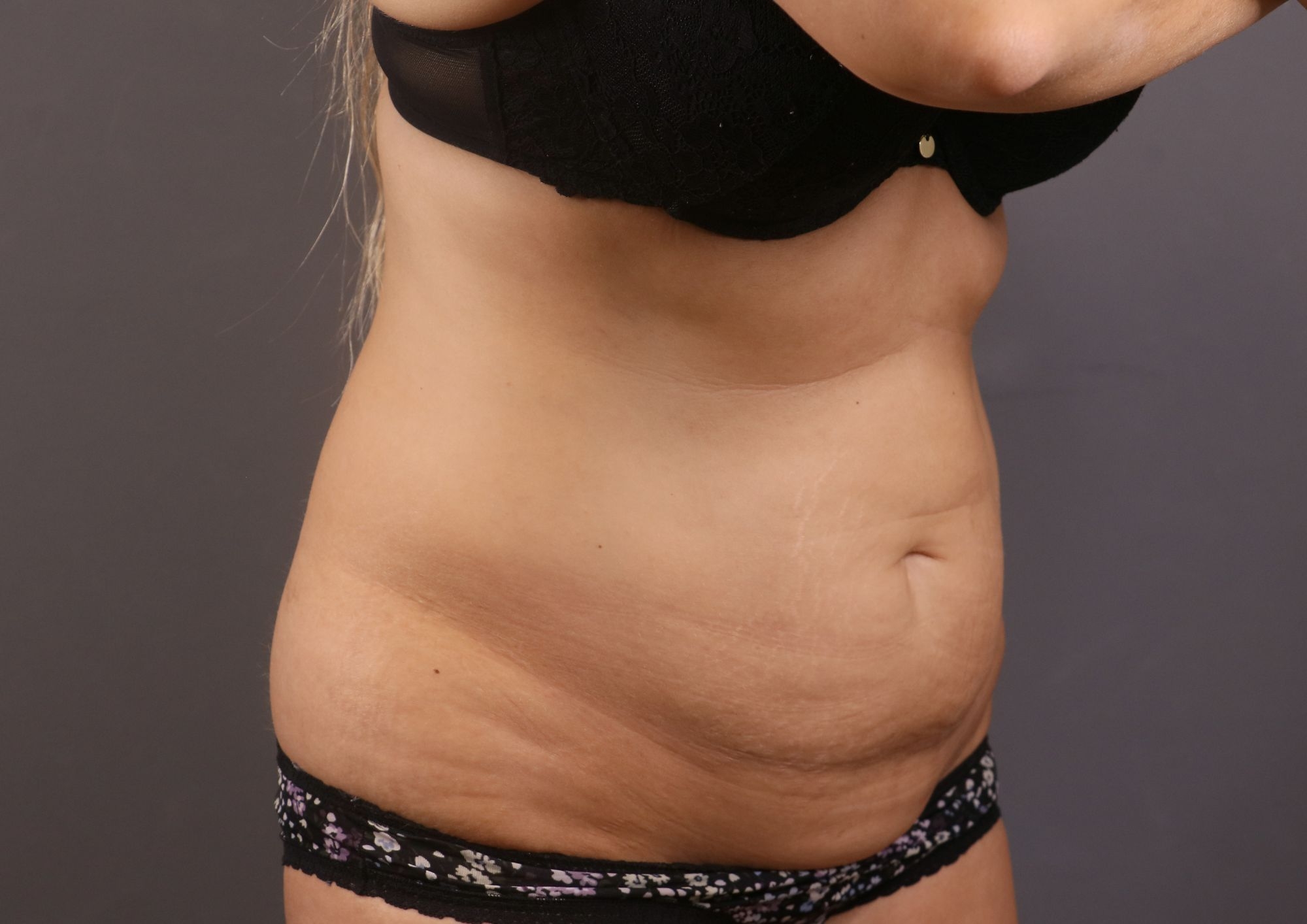 antes y después abdominoplastia castellón