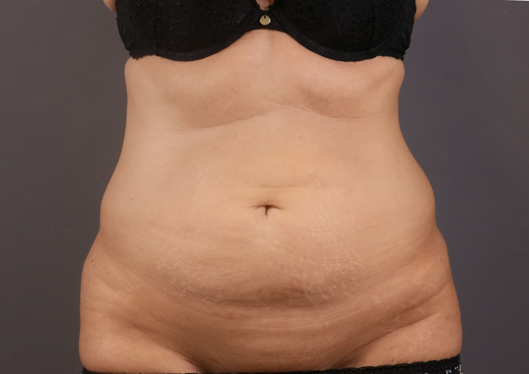 antes abdominoplastia