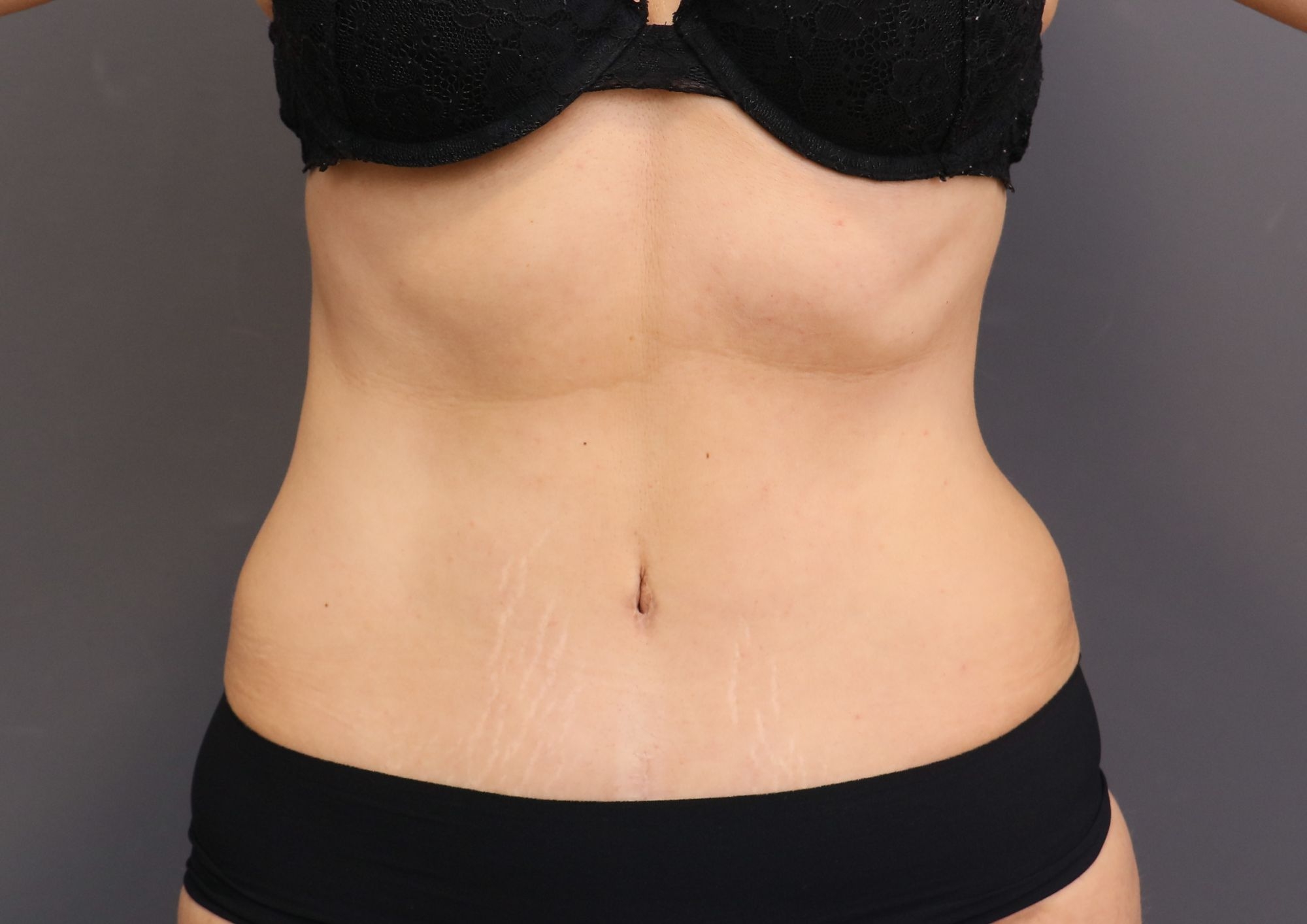 después abdominoplastia