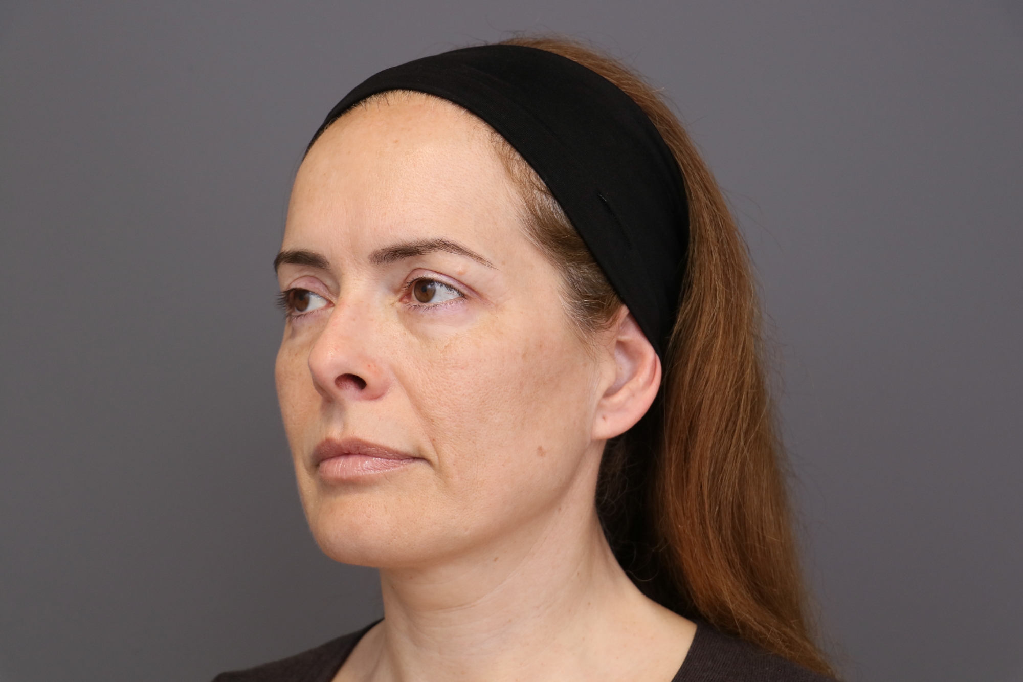 Después blefaroplastia