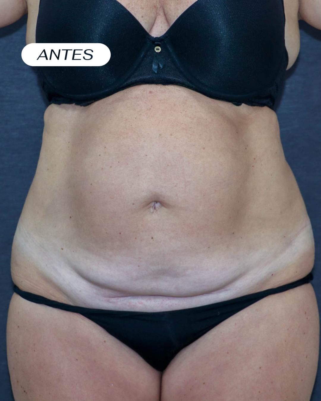 Lipoabdominoplastia