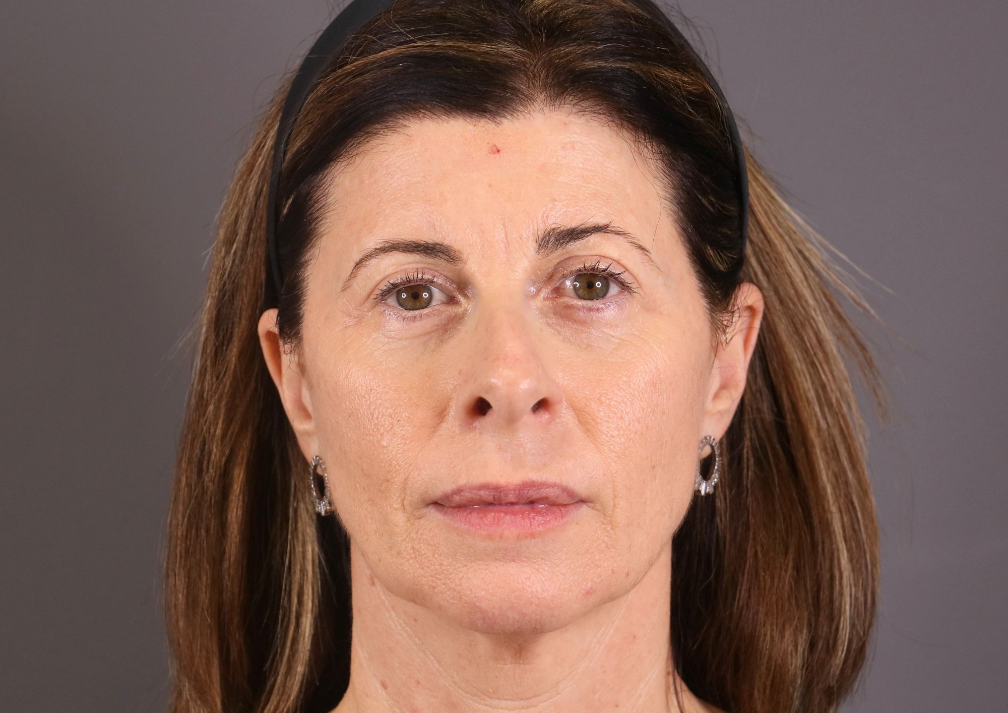 blefaroplastia cirugía párpados