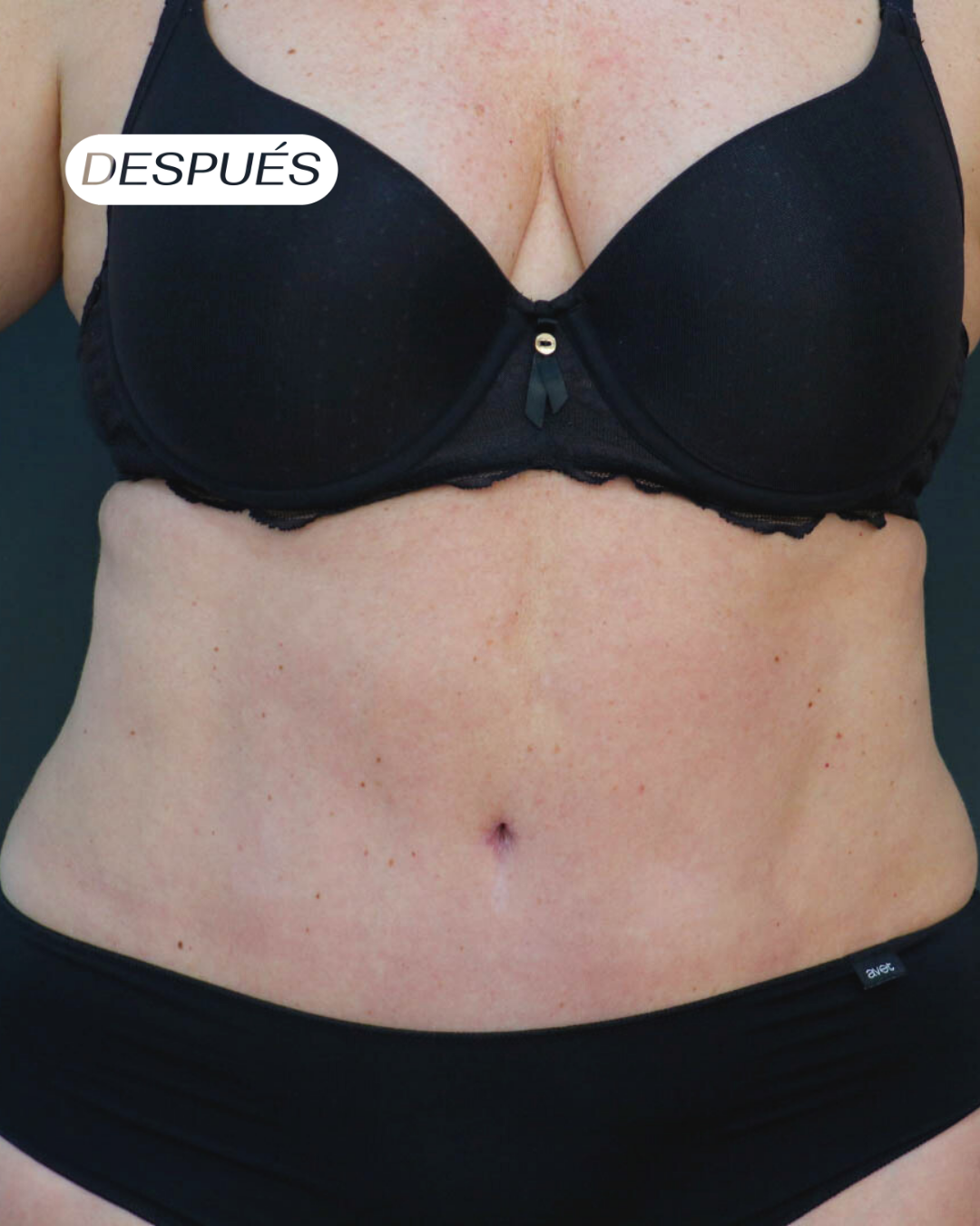 Lipoabdominoplastia