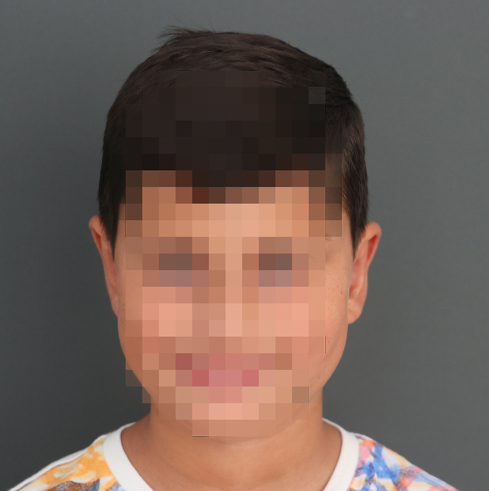 Otoplastia en niño