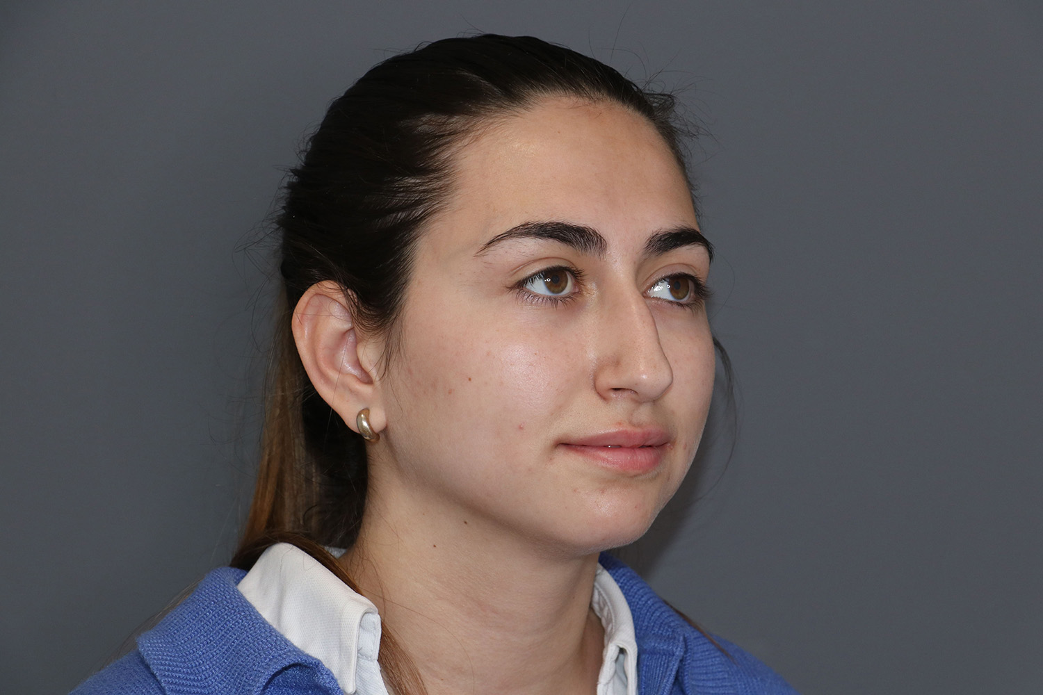 rinoplastia ultrasónica antes
