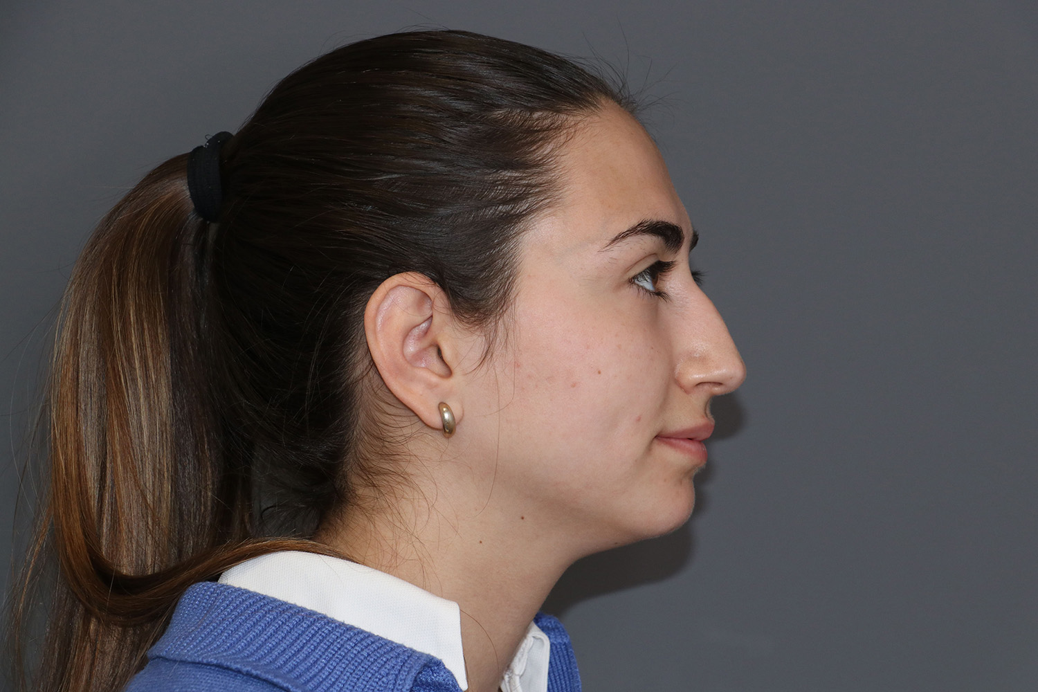 antes y después rinoplastia ultrasónica mujer