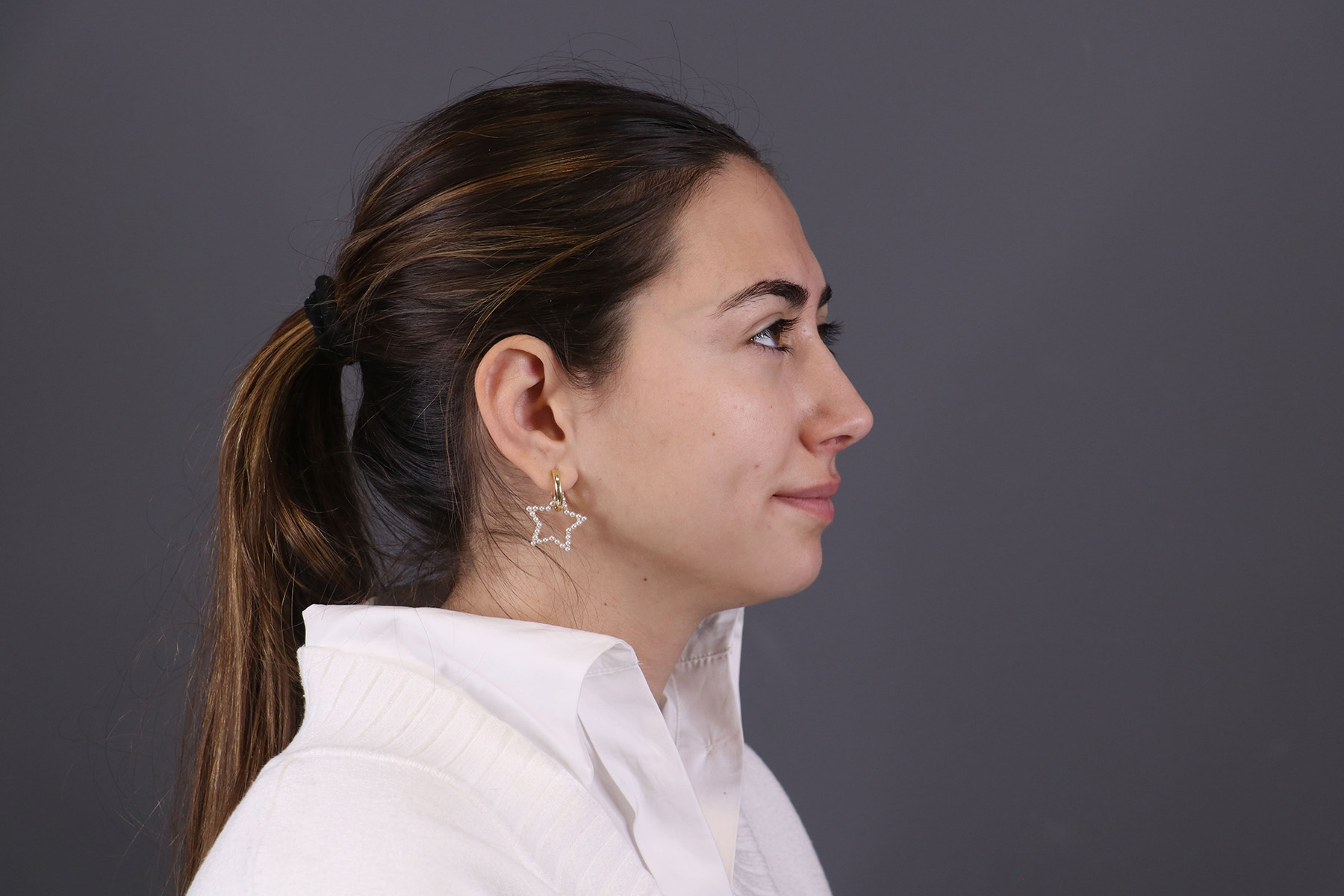 antes y después rinoplastia ultrasónica mujer