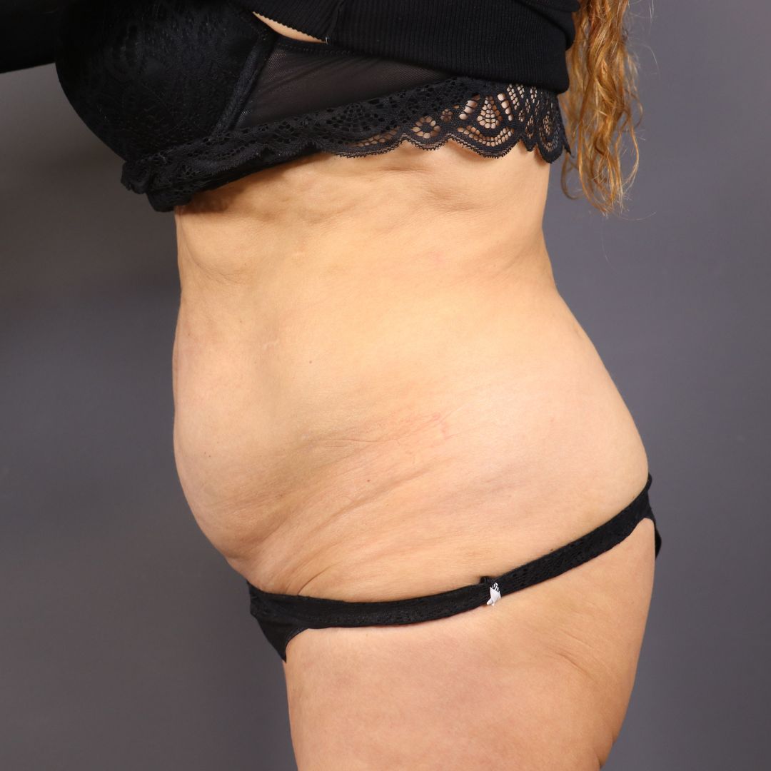 abdominoplastia antes