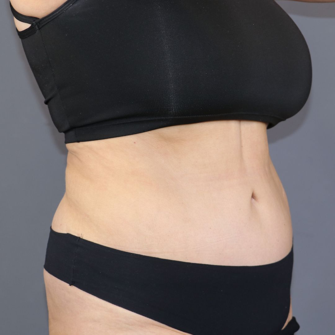 abdominoplastia después