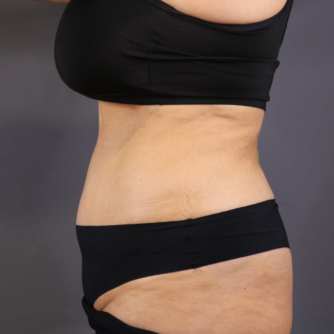 abdominoplastia después