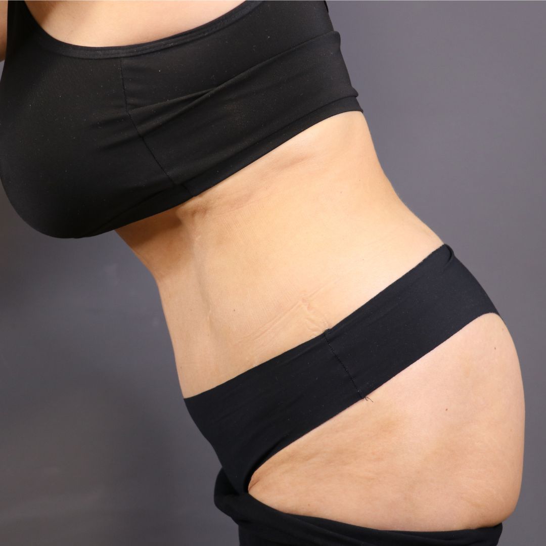 abdominoplastia después