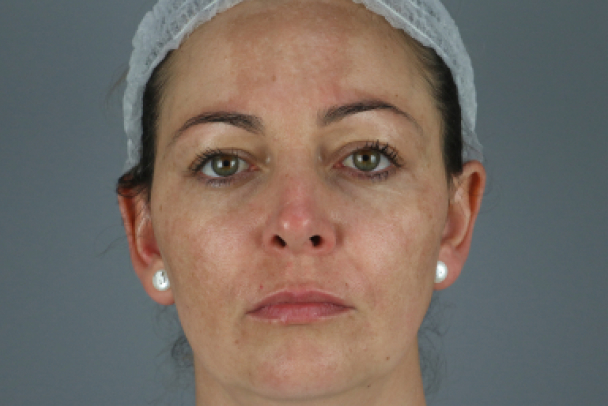 Después de un peeling facial 