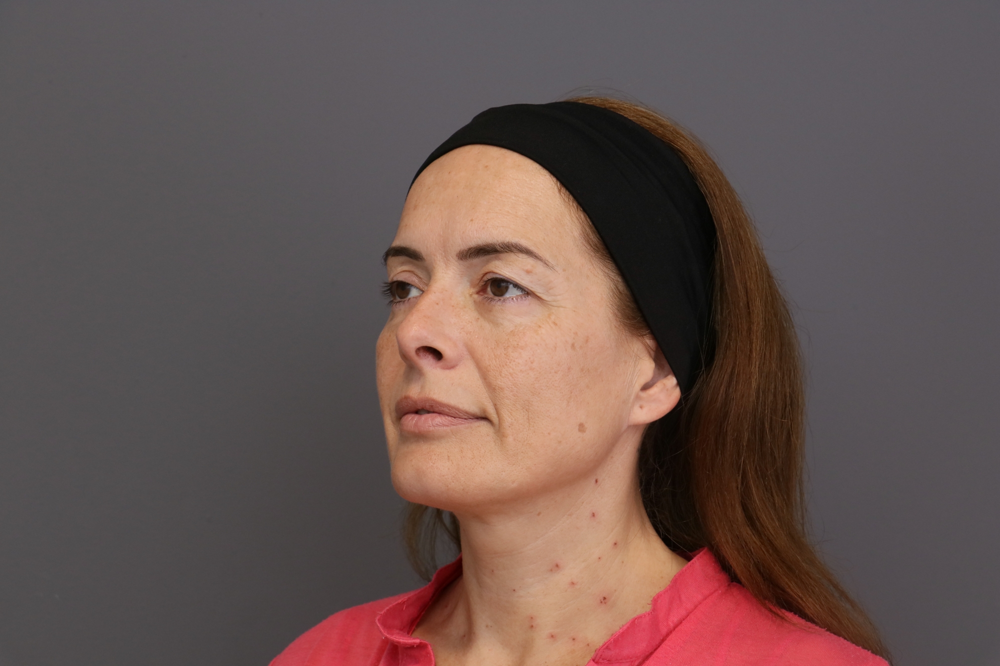 Antes blefaroplastia
