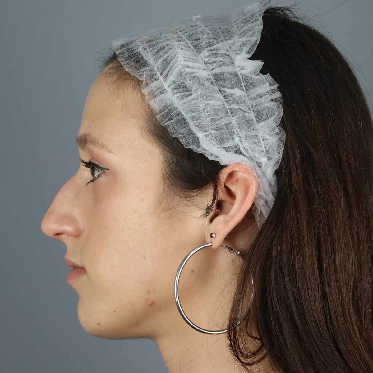 antes y después rinoplastia
