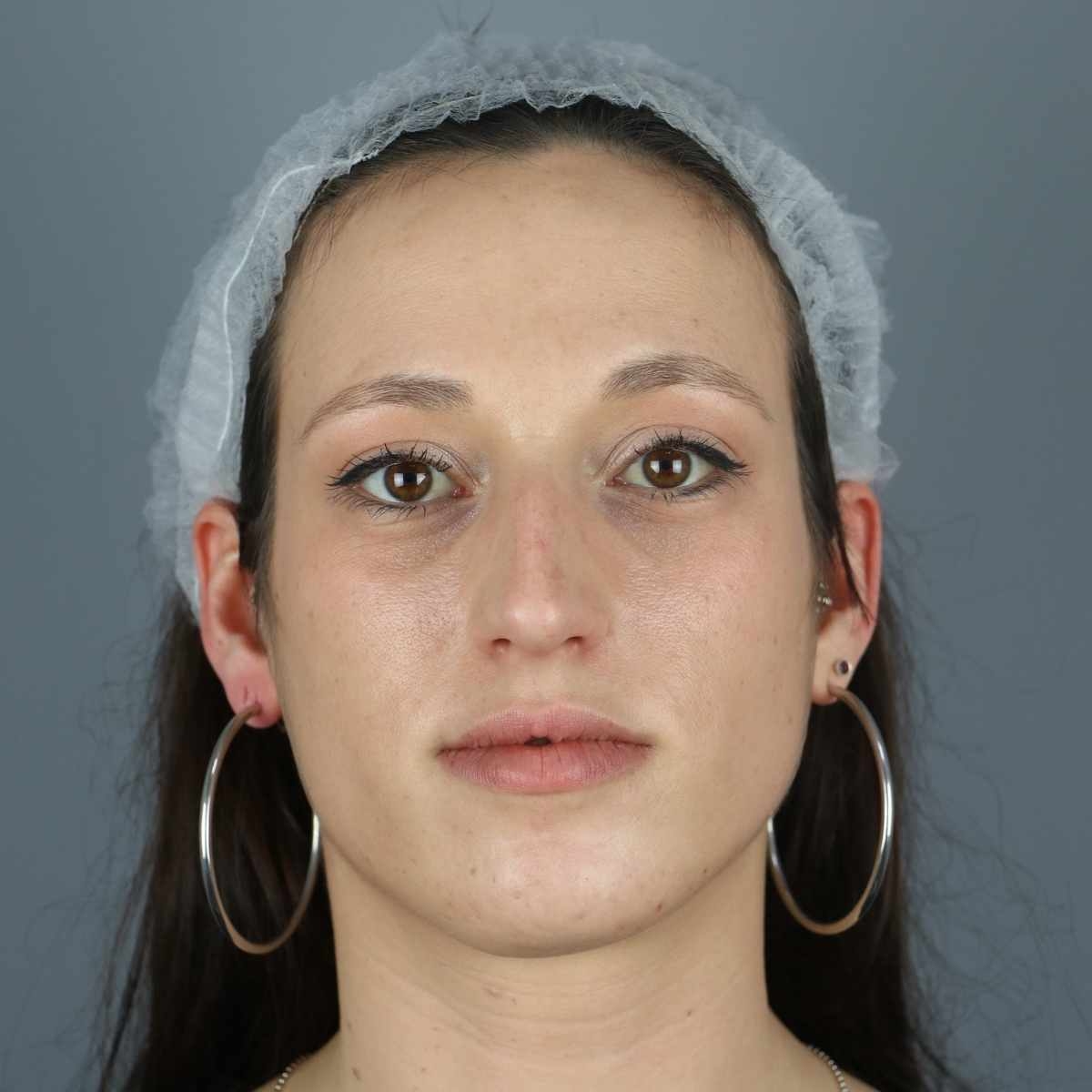 antes rinoplastia ultrasonica 
