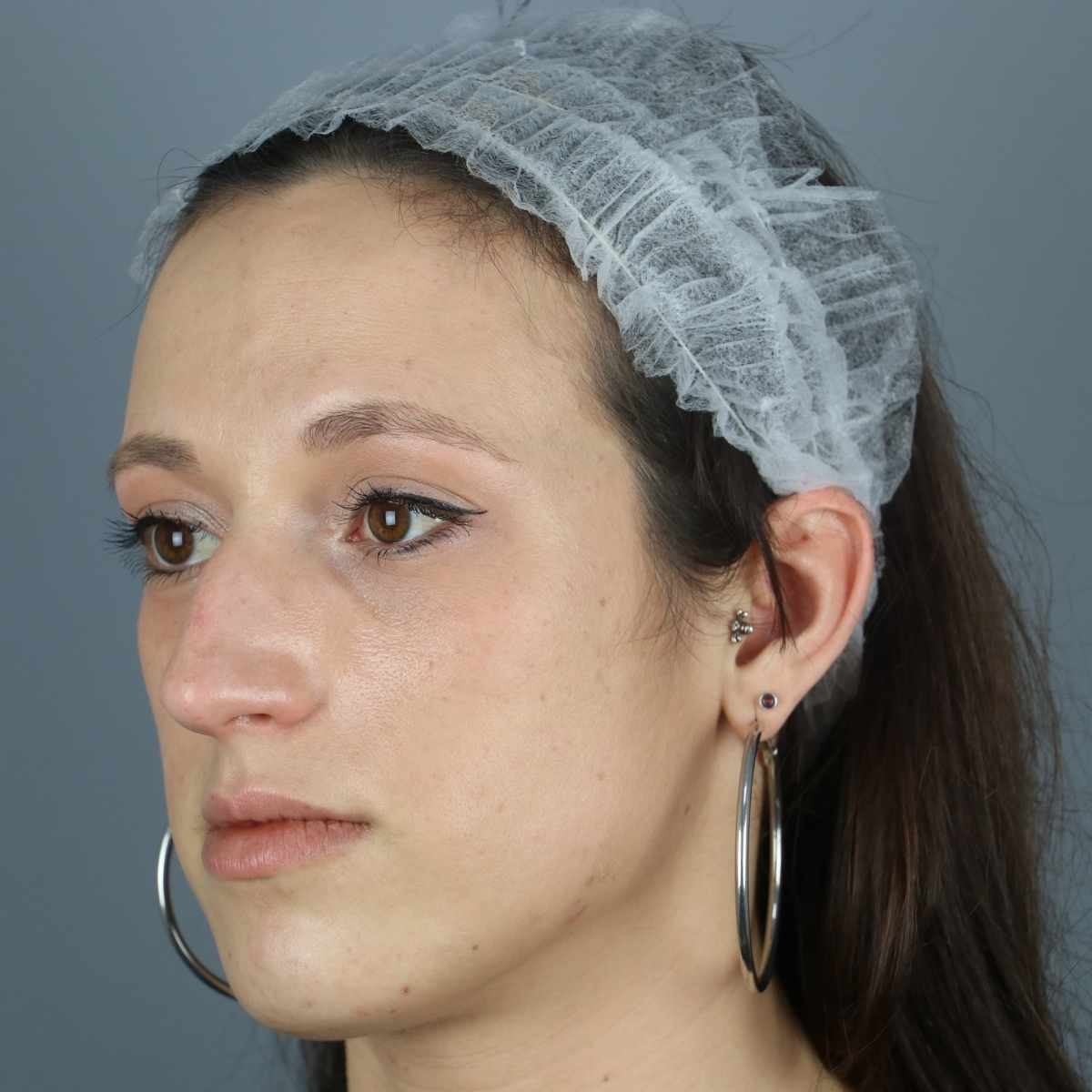antes rinoplastia ultrasonica perfil
