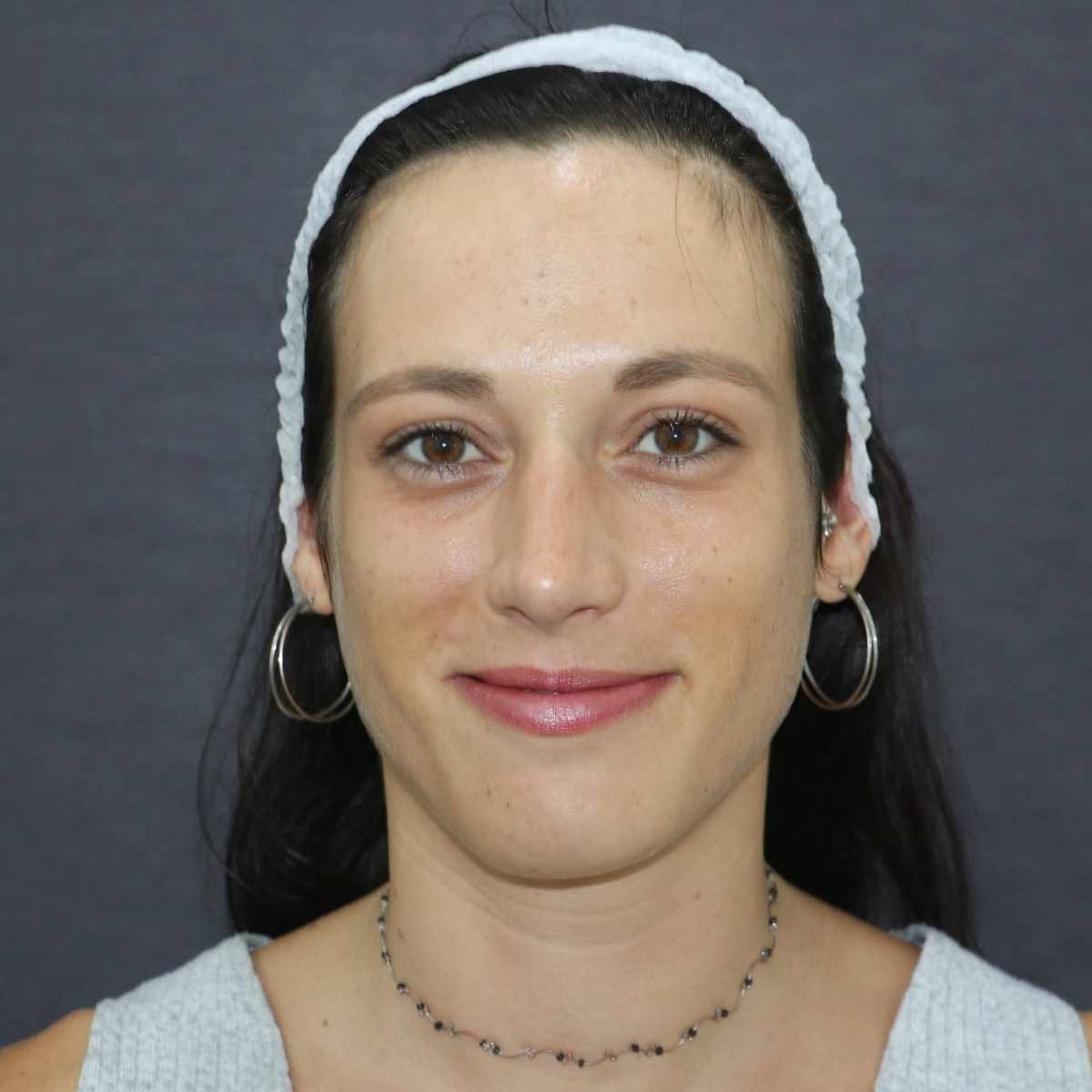 después rinoplastia ultrasonica perfil