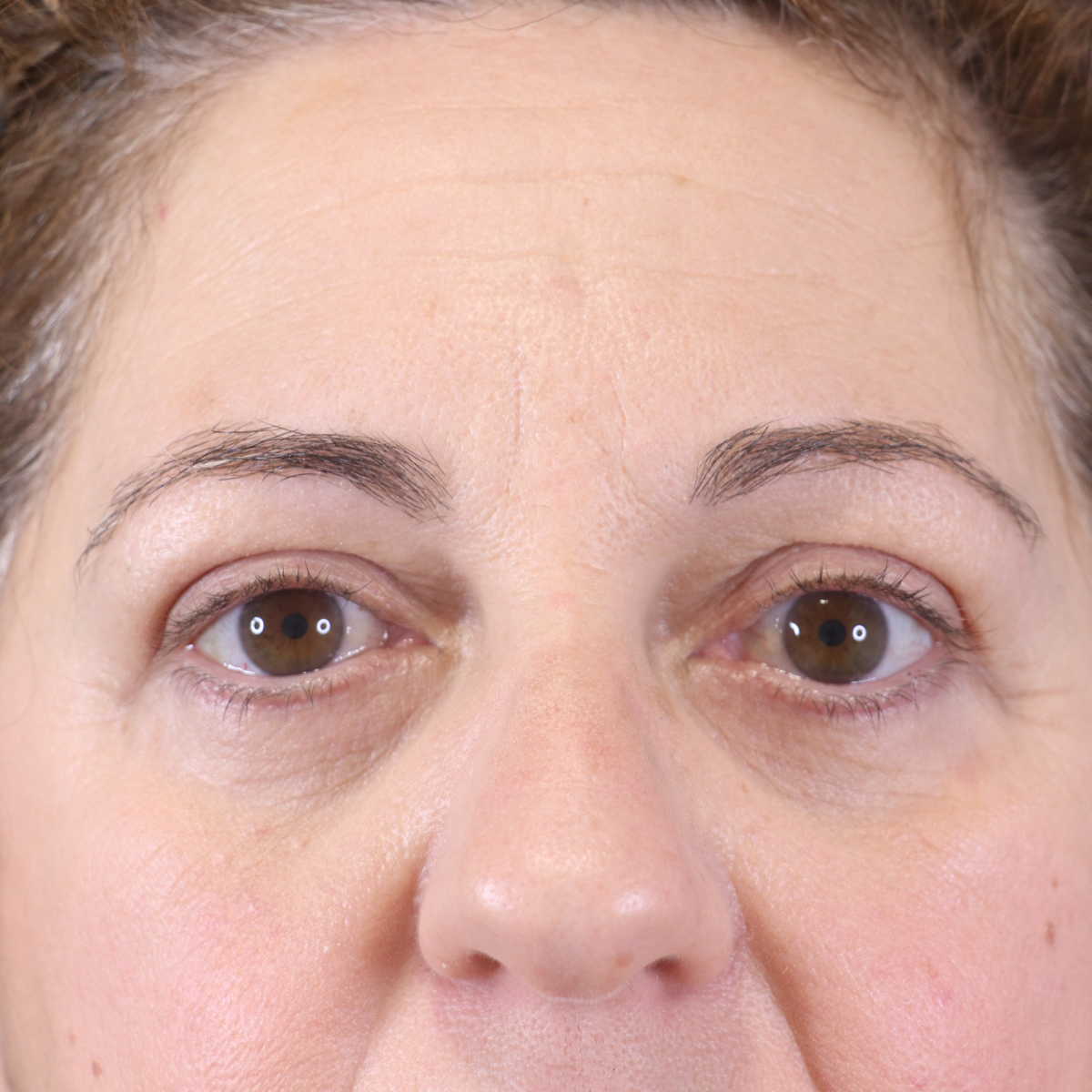 antes y después blefaroplastia