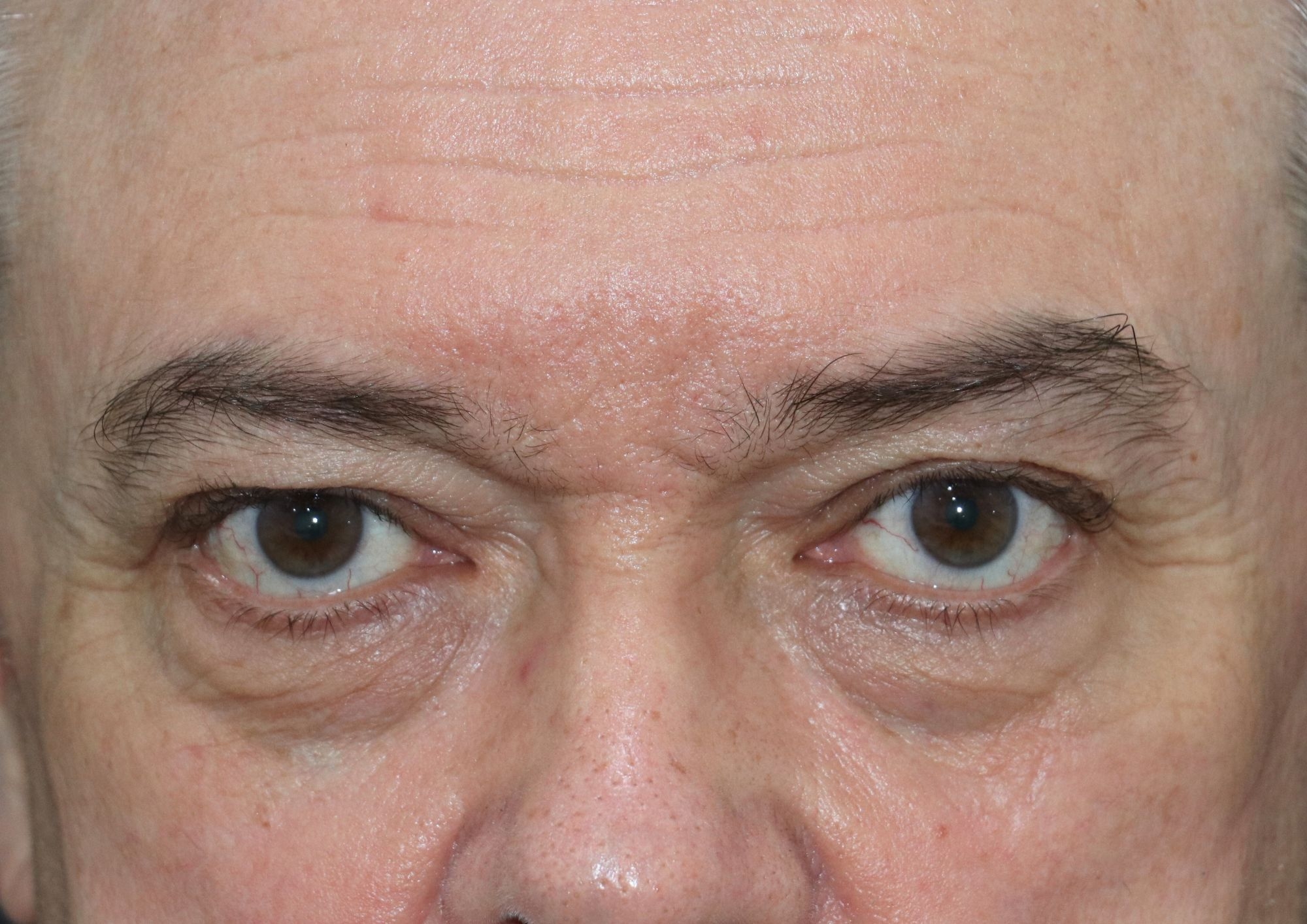 antes y después blefaroplastia hombre