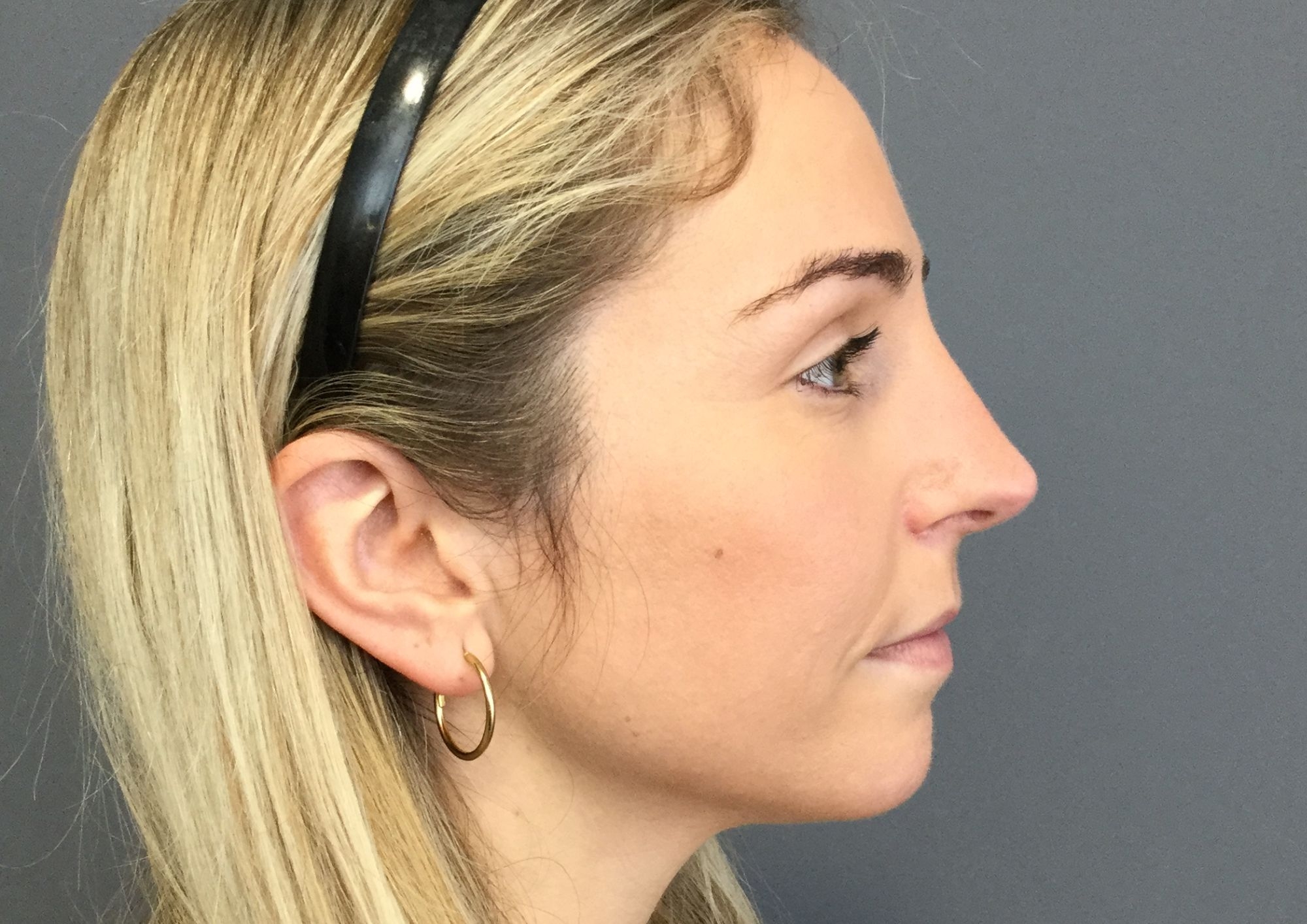 antes y después rinoplastia ultrasónica castellón
