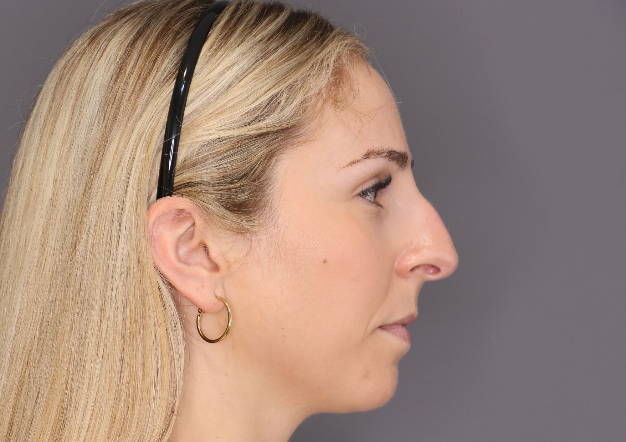 antes y después rinoplastia ultrasónica castellón