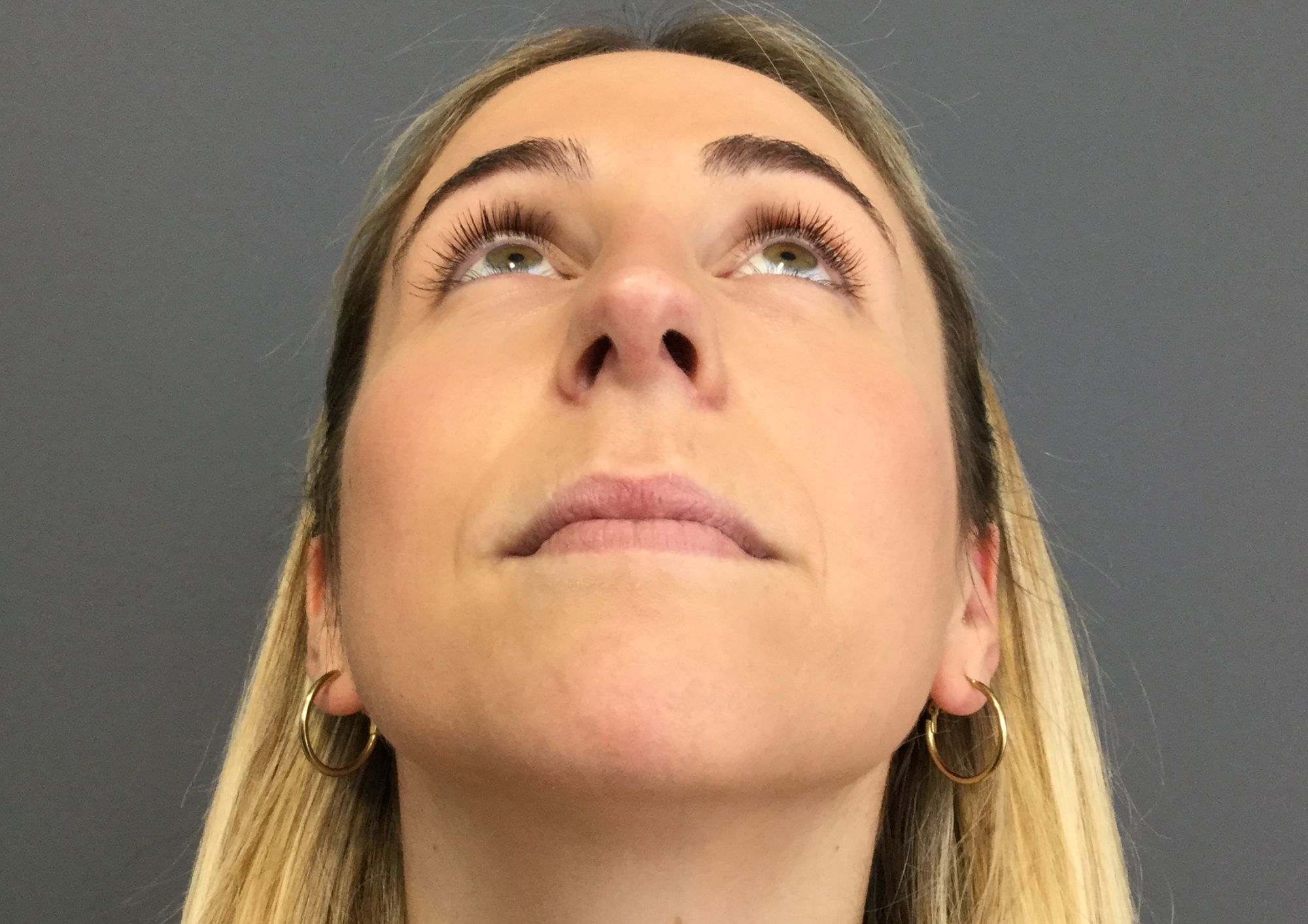 después rinoplastia ultrasónica