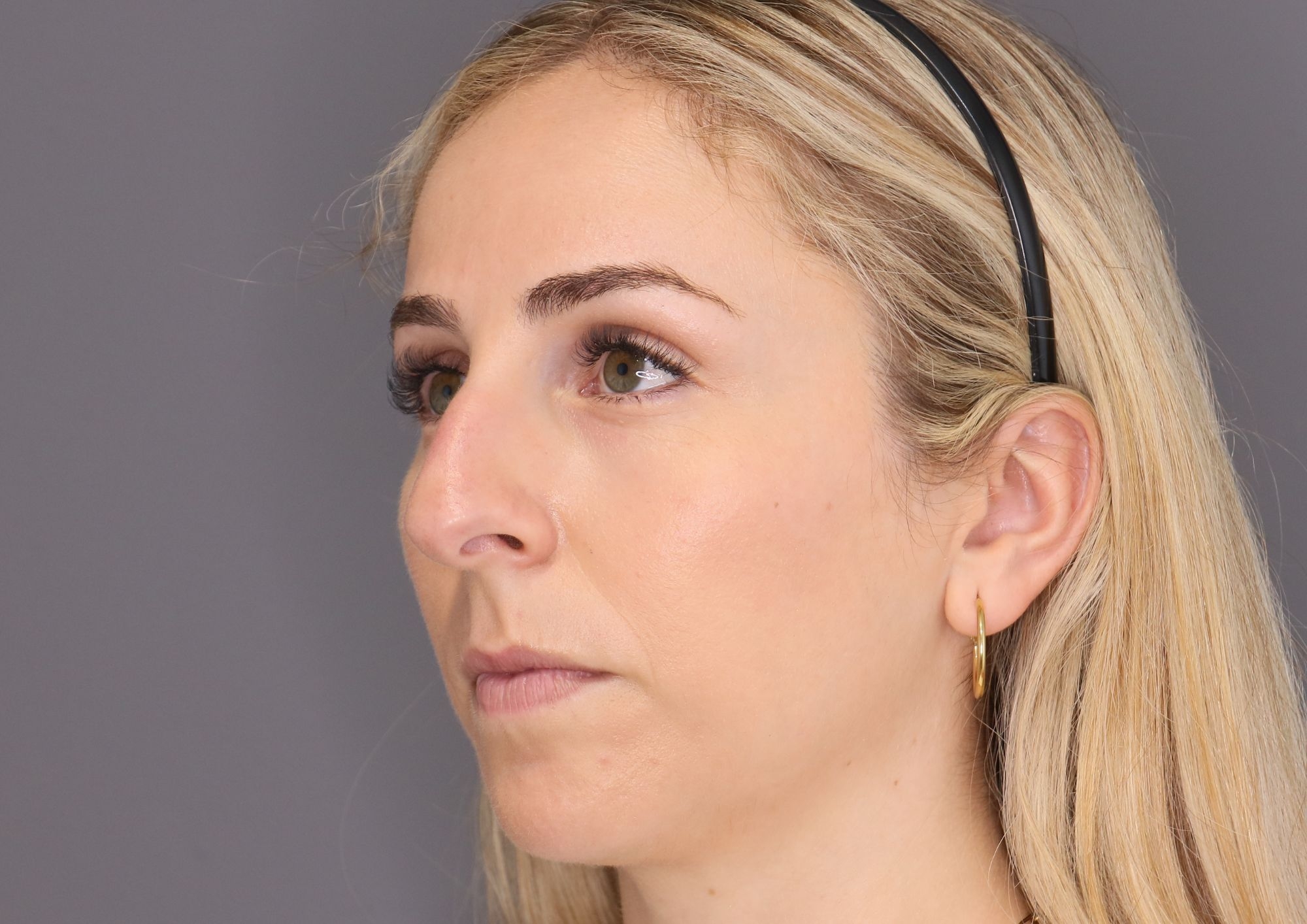antes rinoplastia ultrasónica