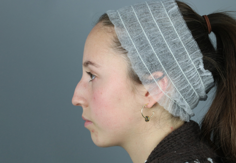 Rinoplastia-perfil-de-mujer-joven