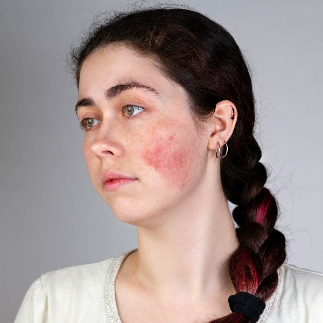 como curar la rosacea