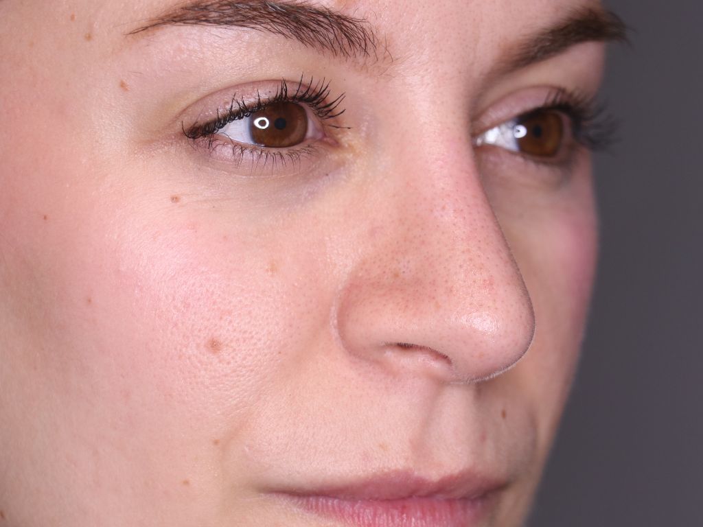 Evolución de una rinoplastia resultados mes a mes