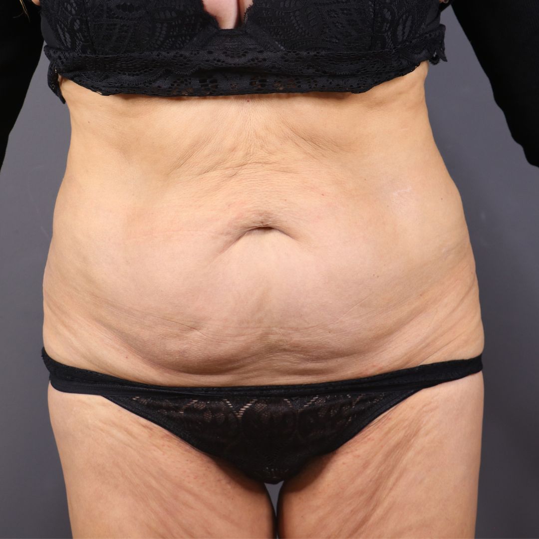 antes y despues abdominoplastia mujer