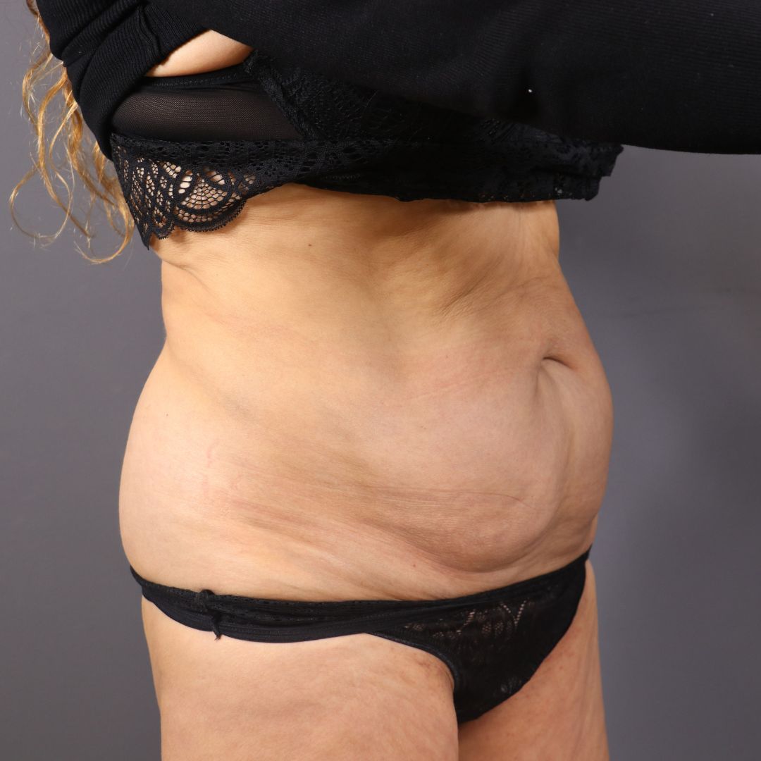 abdominoplastia antes