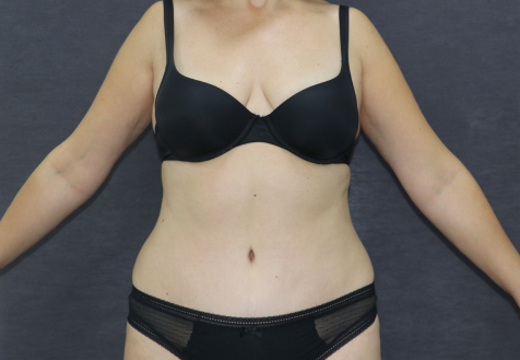 Una lipoabdominoplastia tras embarazos