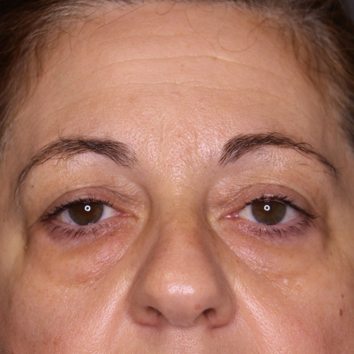 blefaroplastia-antes