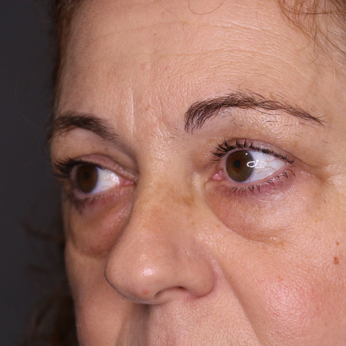 blefaroplastia-antes