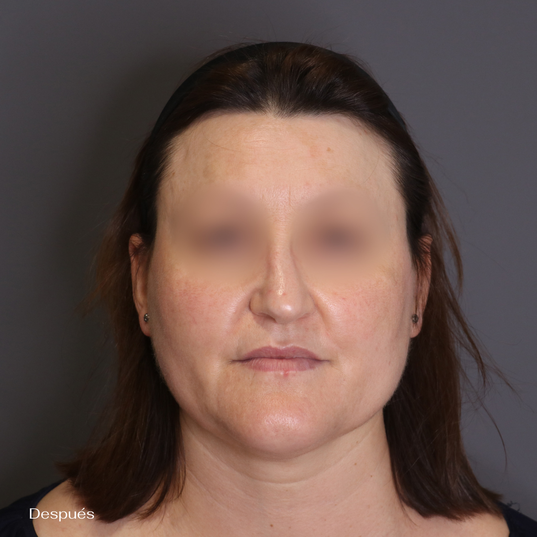 antes y después melasma