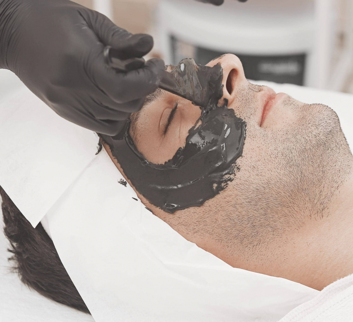Carbon Peel - Tratamiento láser en jordan barres castellón